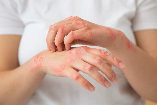 Dermatillomania and Your Hands: What the Damage Really Looks Like