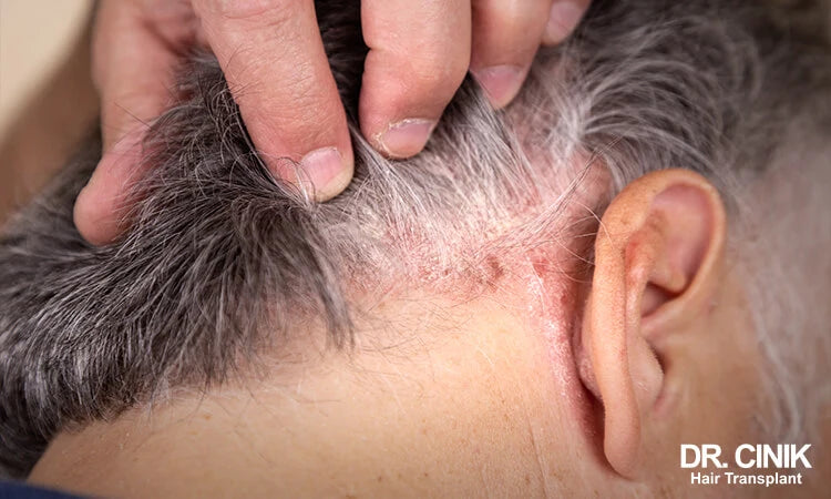 Proven Ways to Heal Scabs on Your Scalp From Picking