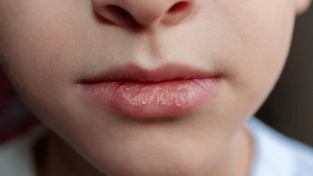 The Role of Collagen Lip Balm in Preventing Lip Sunburn