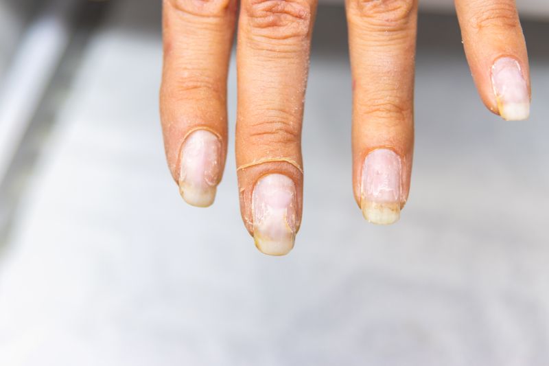 Yellow, White or Streaked: The Truth About Nail Discoloration