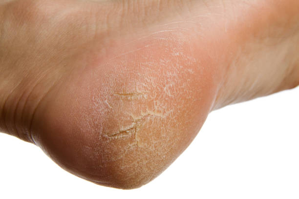Vermont's Natural Cracked Heel Remedy: Effective Home Remedies