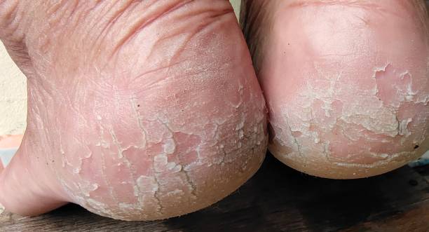 Your Cracked Heels and Foot Odor Might Be Telling You Something Important