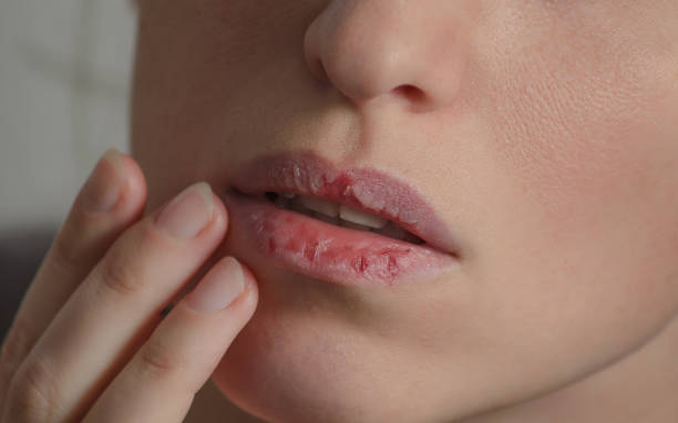 Your Lips Are in Survival Mode And Here’s How to Fix Them