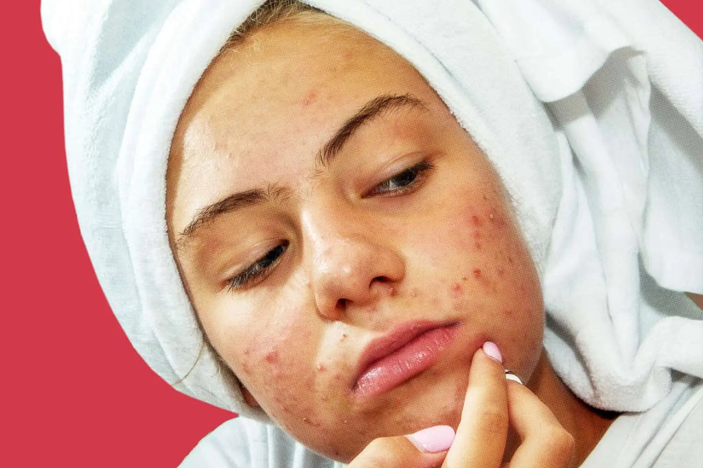 Uncover the Truth About Skin Picking Disorder Symptoms