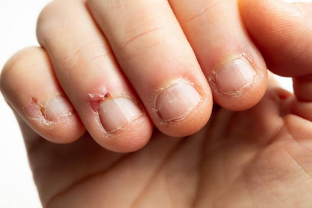 Stop Skin Picking: Break Free from Shame 