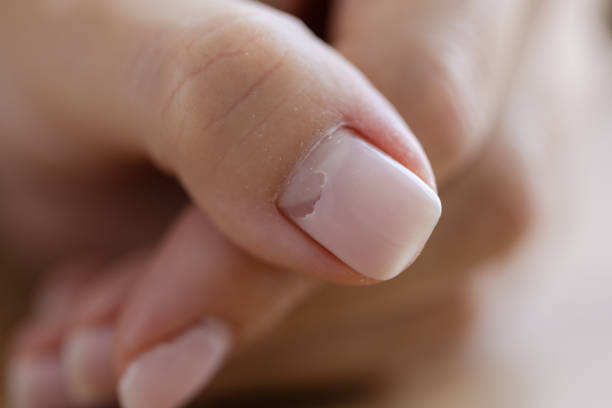 Breaking Free from Post-Polish Picker's Pain: The Reverse Collagen Method