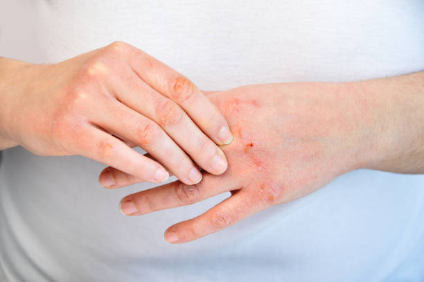 Skin Picking & Habit Reversal Training: 3 Rare Game-Changing Tricks That Work