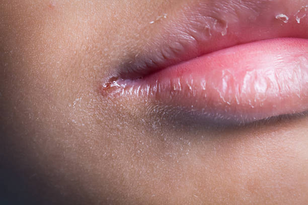 Cracked Lip Corners Got You Hiding Your Smile? Relief for Angular Cheilitis Starts Here