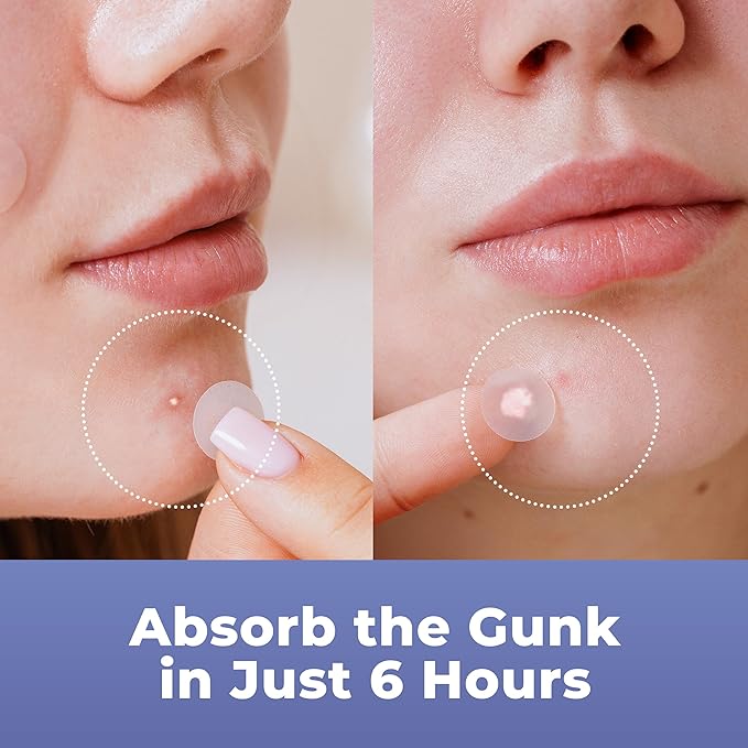 SKIN PICKING & ACNE PACTHES (240 PCS) – HYDROCOLLOID DOTS FOR FACE AND BODY
