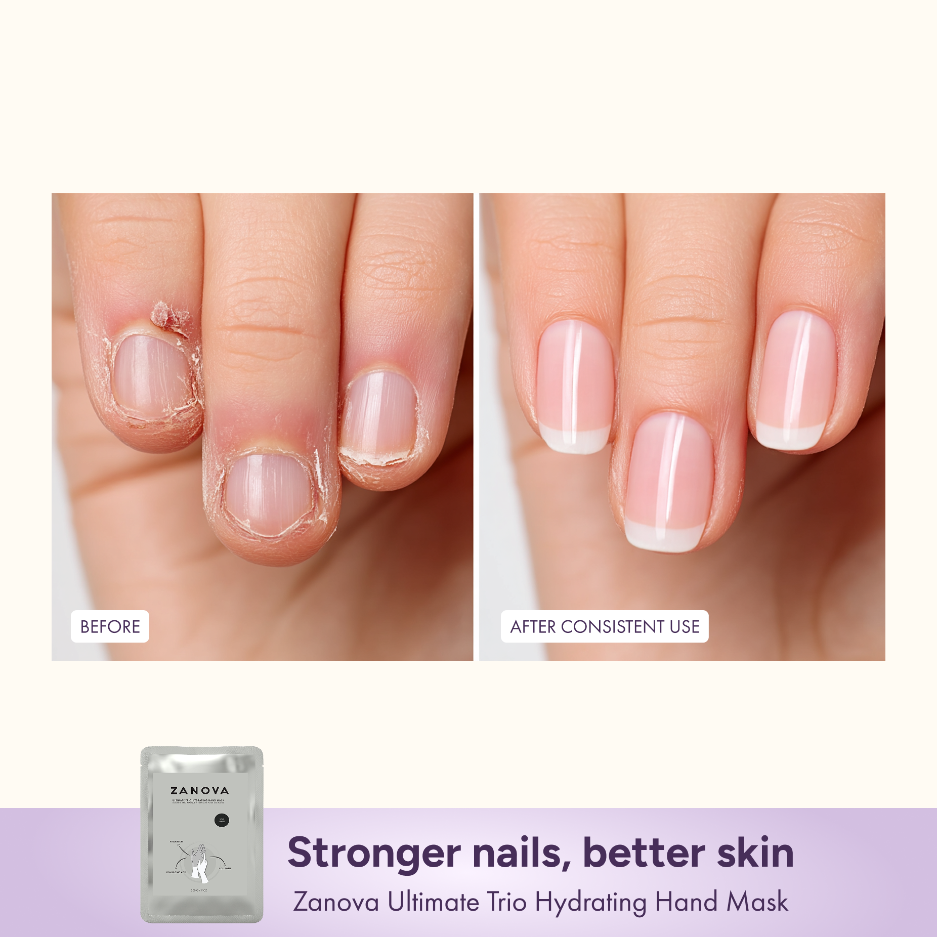 Zanova Collagen Treatment Hand Mask | Hyaluronic Acid, Vitamin C & E | For Skin Picking and Nail Biting Damage | 5 Pairs