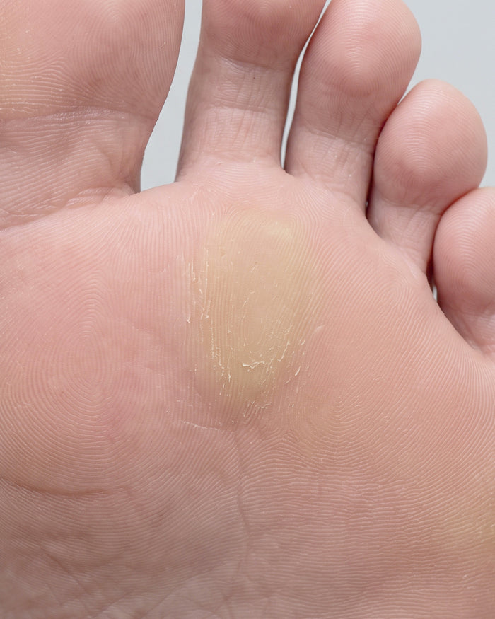 Thick, hard calluses