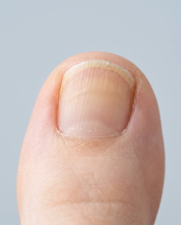 Yellow, brittle nails