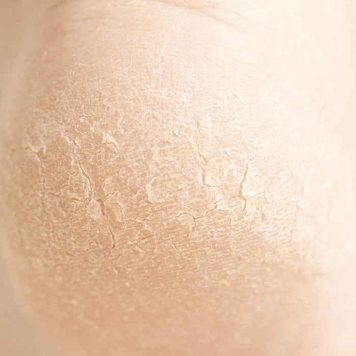 Dry, flaky skin