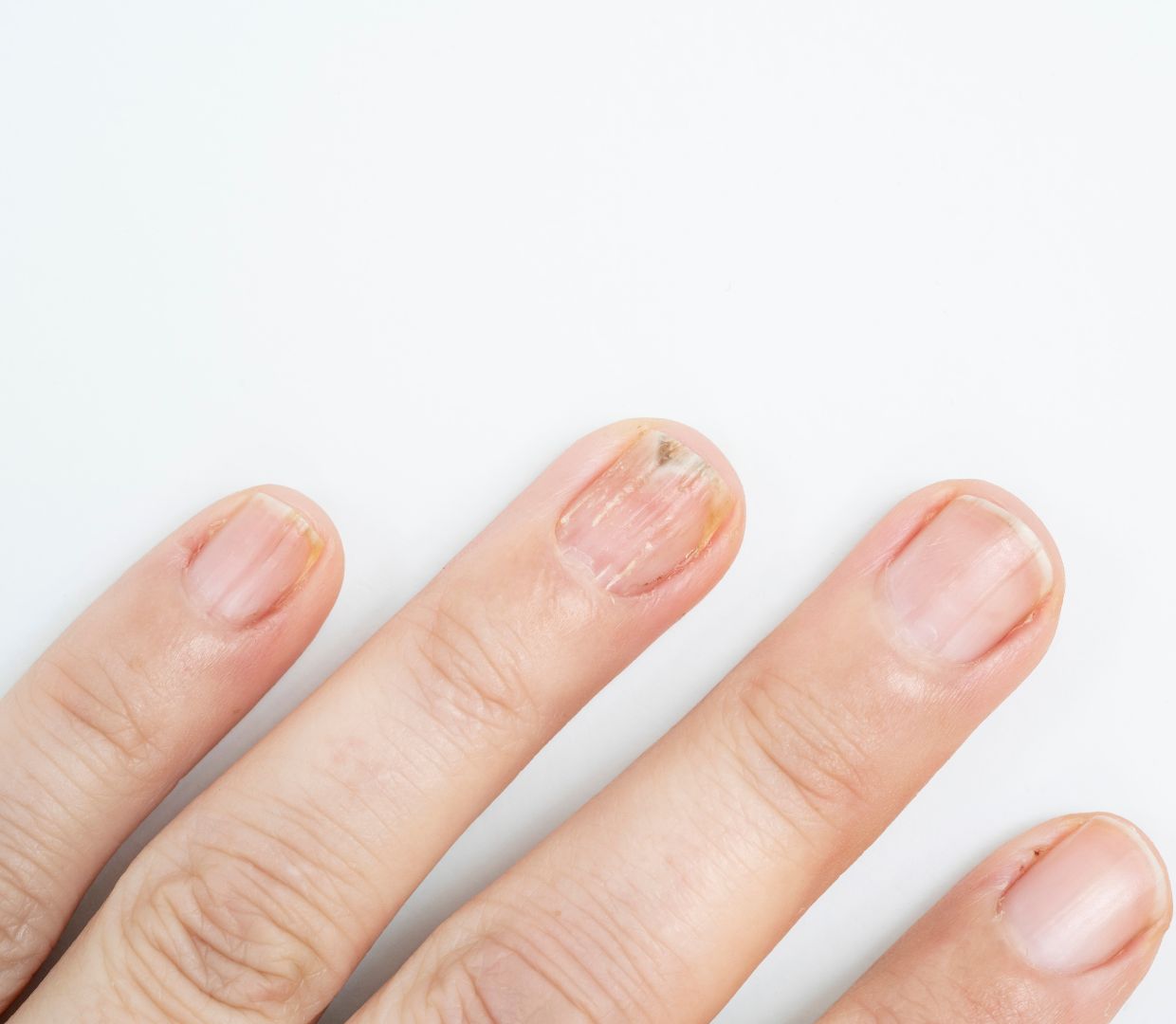 Is biting nails harmful for health? Here's what experts say | Health News -  The Indian Express